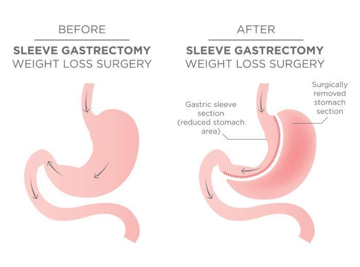 Stomach Staple Bariatric Surgery
