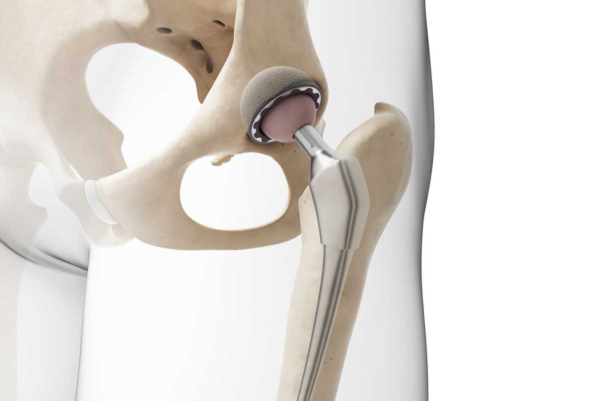 What Happens During Total Hip Replacement? - Magnolia Regional Health Center