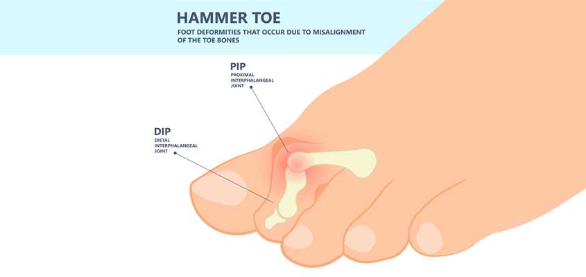 https://www.mrhc.org/wp-content/uploads/2022/08/Hammer-Toe.jpg